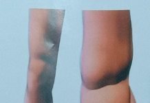 सोमवार से शनिवार तक फाइलेरिया मुक्त अभियान चलेगा..