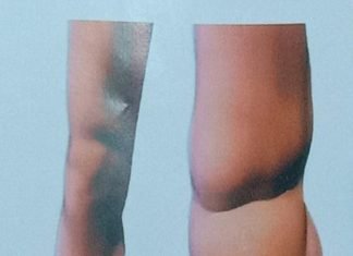 सोमवार से शनिवार तक फाइलेरिया मुक्त अभियान चलेगा..